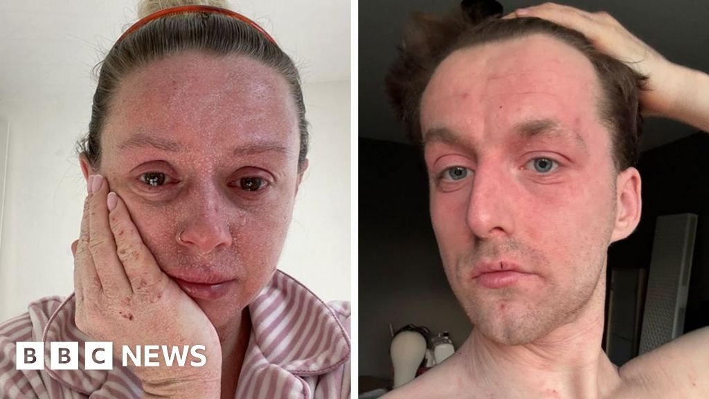 Life with TSW: ‘Our skin is falling off and no-one can tell us why ‘